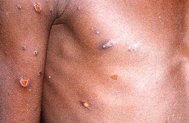 Variole du singe : Une dizaine de cas signalés dans le Sud-Ouest