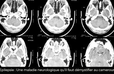 Epilepsie : Plus de deux cent décès enregistrés en 2024 au Cameroun