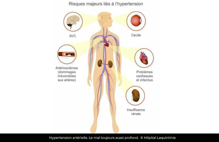 Hypertension artérielle : Plus de mille morts enregistrés au premier trimestre 2025 au Cameroun