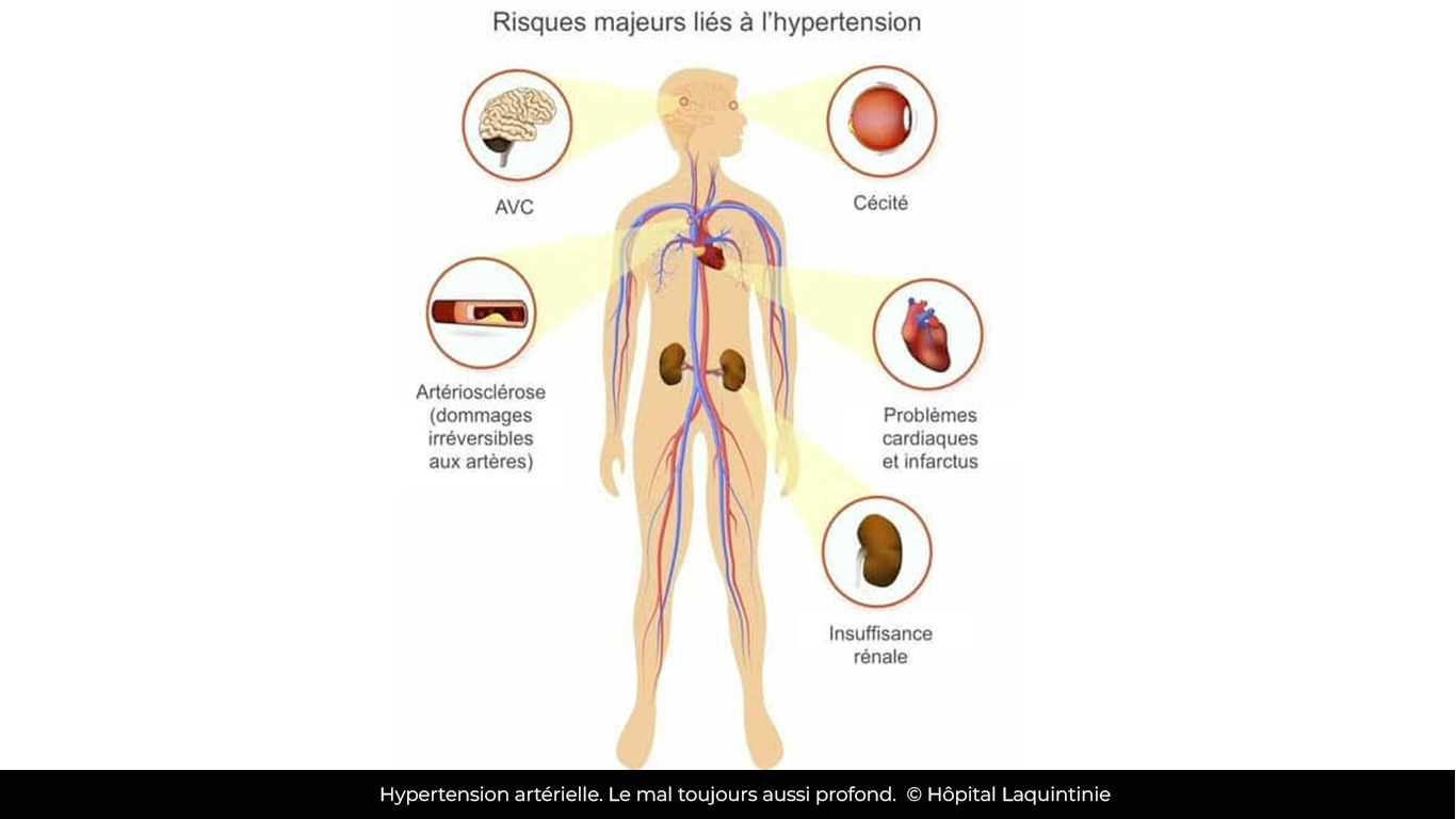 Hypertension artérielle : Plus de mille morts enregistrés au premier trimestre 2025 au Cameroun