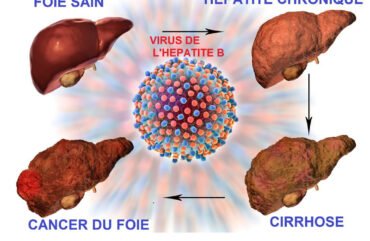 Vacances sans sida : l’hépatite B, plus contagieuse que le VIH