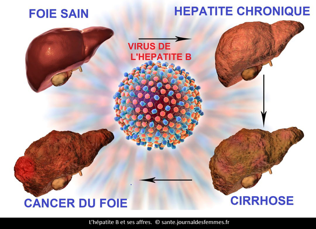 Vacances sans sida : l’hépatite B, plus contagieuse que le VIH