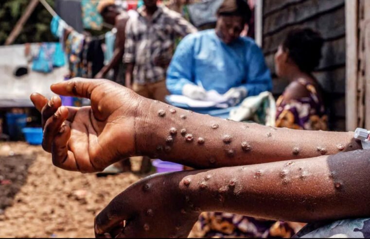 Santé : Déjà 78 cas de Mpox détectés au Cameroun