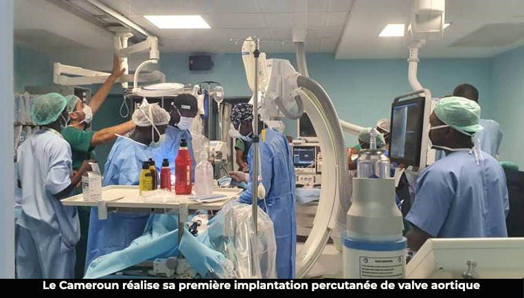 Santé : la toute première implantation d’une valve aortique par voie trans-cathéter réalisée au Cameroun