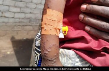 Variole du singe : un cas confirmé à l’Ouest