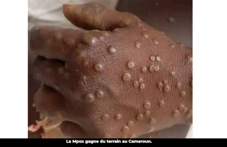 Variole du singe : 11 cas confirmés dans le Sud