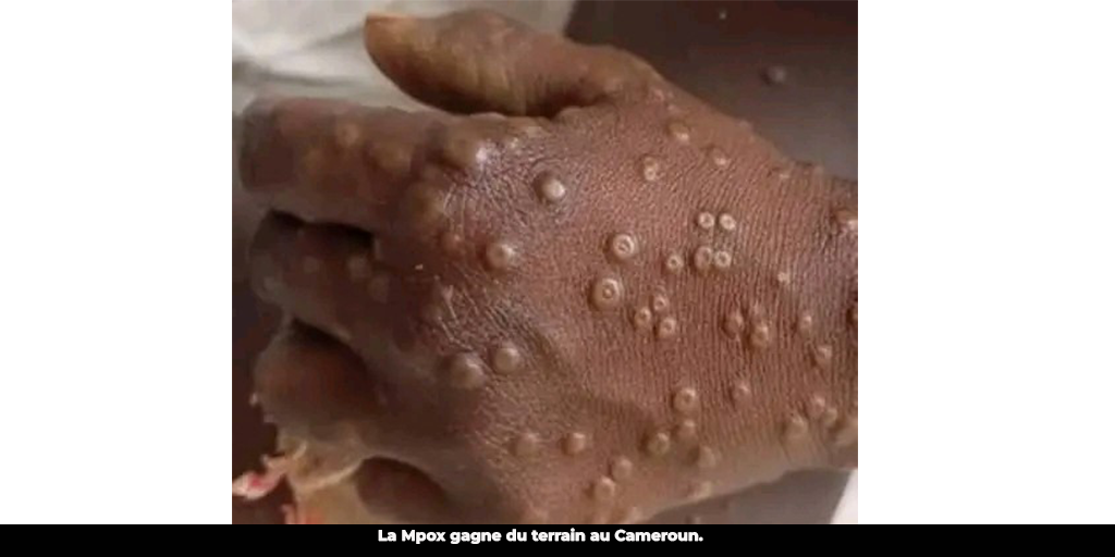 Variole du singe : 11 cas confirmés dans le Sud